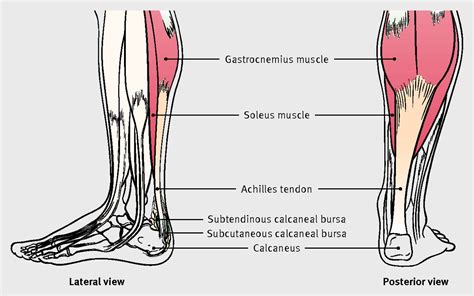 Achilles tendon disorders | The BMJ