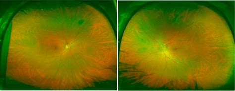 Optos photos showing (a) normal right fundus and (b) left optic nerve... | Download Scientific ...