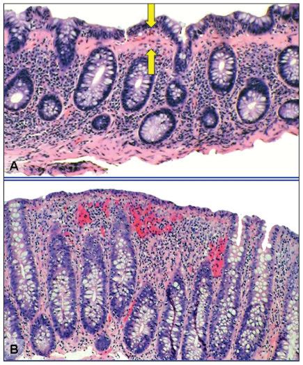 Histological picture which shows lymphocytic infiltration in