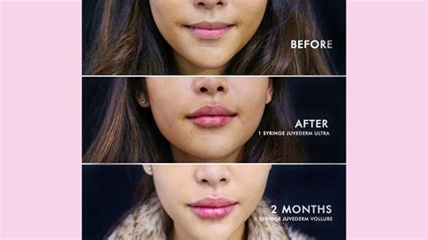 Juvederm Ultra Before And After Lips | Lipstutorial.org