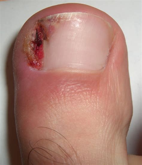 Ingrown toenails infection | Skin & Hair problems articles | Body & Health Conditions center ...