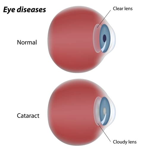 Peters plus syndrome: MedlinePlus Genetics