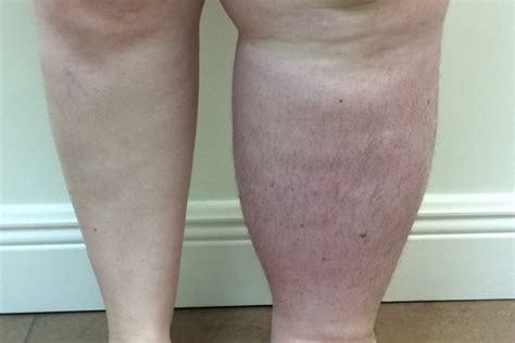 LYMPHEDEMA – Dermatology Conditions and Treatments