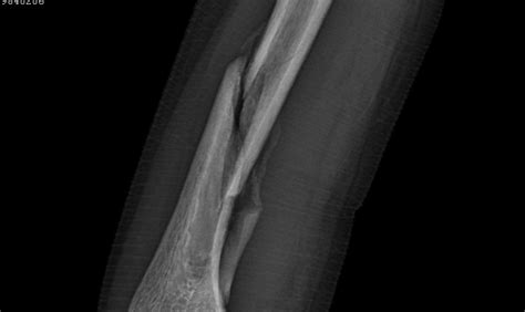 Spiral fracture causes - contentbatman