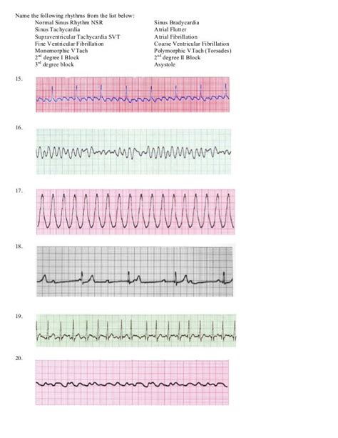 ACLS EKG Rhythms