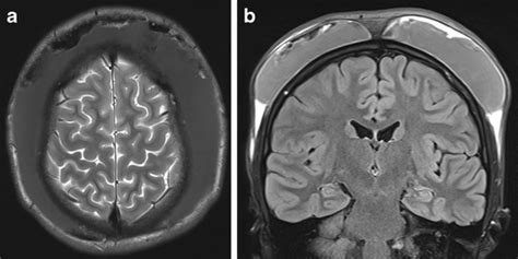 Subgaleal Hematoma | SpringerLink