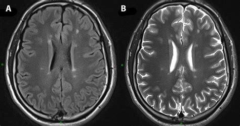 Axial FLAIR (left) and T2 (right) brain MRI show multiple lesions... | Download Scientific Diagram