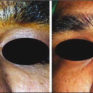 Lesion was excised with a horizontal elliptical incision (left) with... | Download Scientific ...