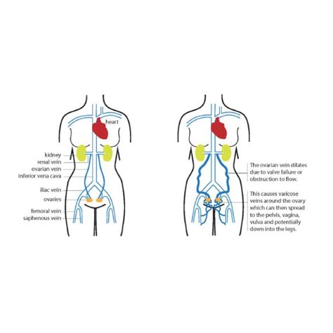 Pelvic Congestion Syndrome