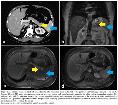 Intrapancreatic Accessory Spleen: Investigative Dilemmas and Role