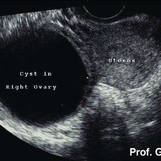 Ovarian Daughter Cyst Ultrasound