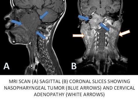 Nasopharyngeal Cancer| symptoms, stages, treatment, survival, FAQs