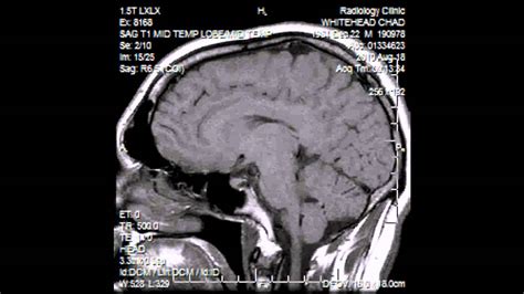 Irresti: Corticobasal Degeneration Mri Radiopaedia