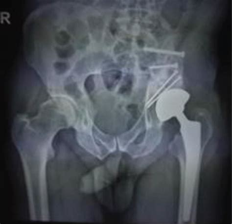 Hip arthroplasty—3 months after surgery. | Download Scientific Diagram