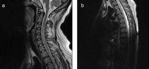 The key slices of the spinal cord MRI images of the case 1. (a)... | Download Scientific Diagram