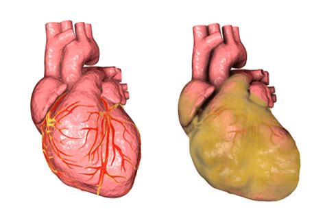 Ventricular Hypertrophy : Causes, symptoms, types, & treatment | FactDr