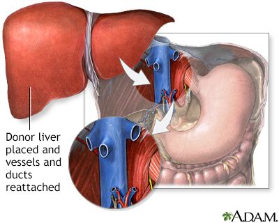 Liver transplant Information | Mount Sinai - New York