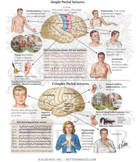 Alcohol Seizures Treatment: Complex Partial Seizure Disorder Treatment