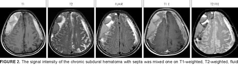 Subdural Hematoma Mri