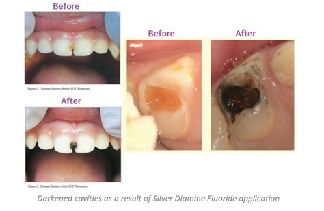 Silver Diamine Fluoride (SDF) Treatment – Kaunakakai HI | Nalu Dental