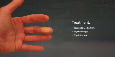 Raynaud Disease Treatment: Improving Blood Flow