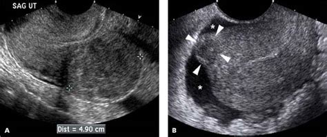 Myometrium | Radiology Key