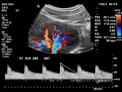 Normal Kidney Ultrasound