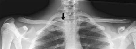 Serendipity View Radiograph Of A Right Sided Posterior Sternoclavicular ...