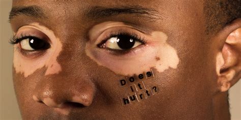 This Photographer Is Documenting the Realities of Living With Skin ...