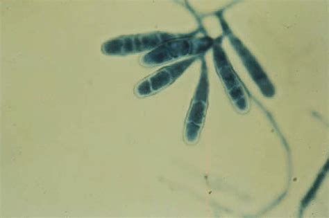 Mycotic Diseases - Clinical Tree