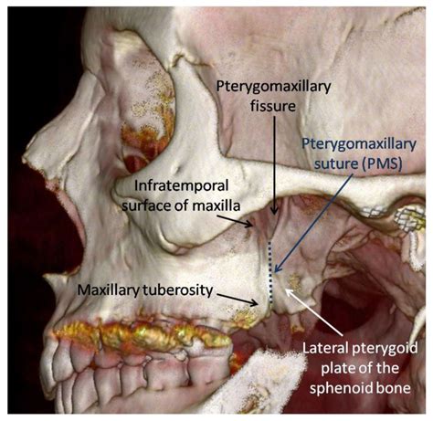 Lateral Pterygoid Plate Of Sphenoid Bone