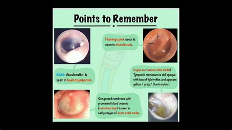 Tympanic membrane colour in different conditions #doctor #shortsfeed #short - YouTube