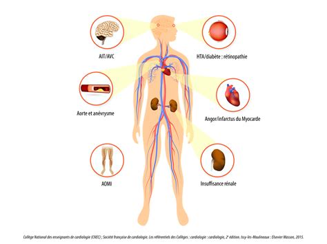 Diabète et Complications cardio-vasculaires | Diabète 66