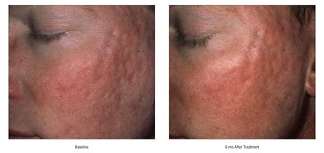 Treatment of Atrophic Facial Acne Scars With the 1064-nm Q-Switched Nd:YAG Laser | Acne | JAMA ...