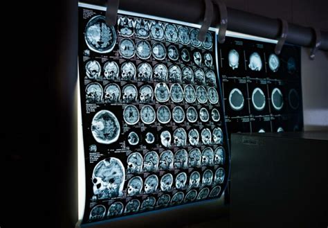 FDA Ups ARIA Monitoring for Aduhelm; Doubles MRI Requirement | Being Patient