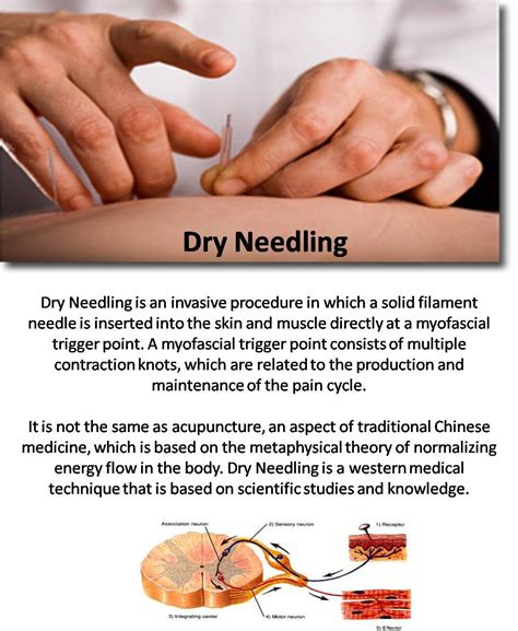 Dry Needling - @Emilie Claeys Claeys Peterson | Dry needling therapy ...