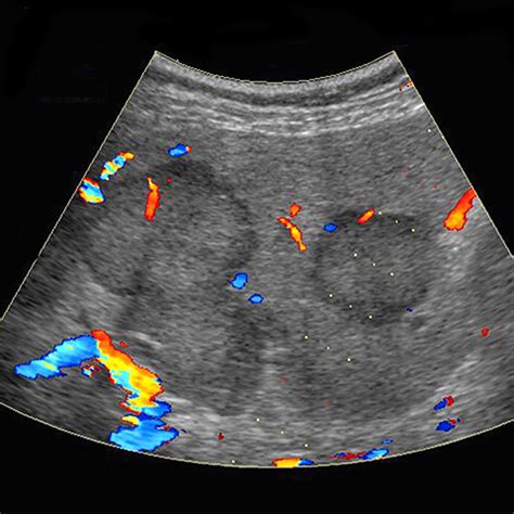 Liver Cancer: Ultrasound Liver Cancer