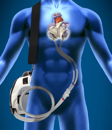 Left Ventricular Assist Devices Replaced by SynCardia Total Artificial Heart in 7 Patients