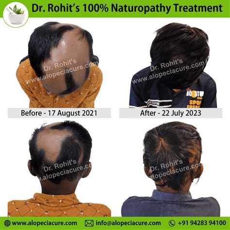 ophiasis alopecia areata treatment