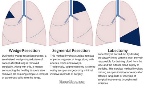 Lung Cancer Treatment: Surgery Procedures, Risks and FAQs