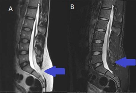 Tethered Cord Syndrome Associated With Lumbar Lipomyelomeningocele: A ...