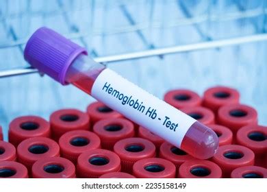 Hemoglobin Hb Test Look Abnormalities Blood Stock Photo 2235158149 ...