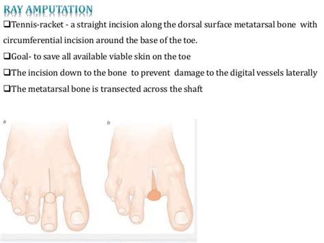 Amputation- Dr. Kiran Kumar G.