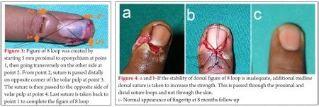 Finger tip injury; nail bed laceration; partial nail plate avulsion; complete nail plate ...