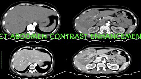 Ct abdomen triple phase contrast enhancement - YouTube