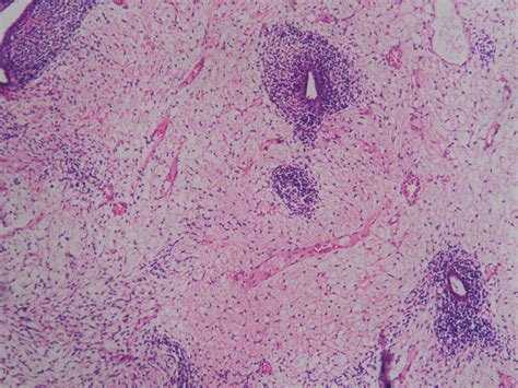 SARCOMA BOTRYOIDES (EMBRYONAL RHABDOMYOSARCOMA ) – CERVIX ...