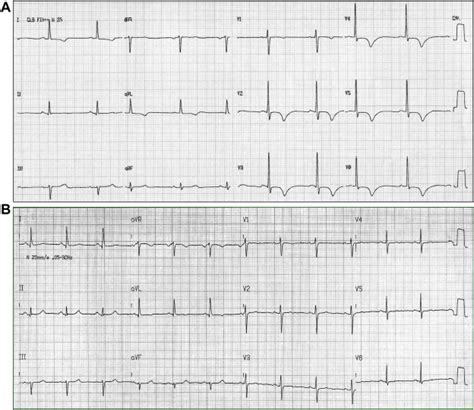 Left septal fascicular block: Evidence, causes, and diagnostic criteria ...