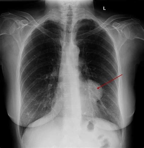 Cureus Thymoma Presenting As A Pleural Based Mass | The Best Porn Website