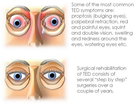 Thyroid eye disease (TED) - Grave´s disease