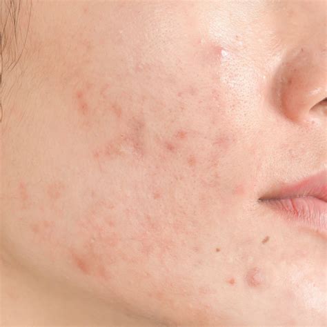 Adult Acne Causes And How To Get Rid Of It, Say, 59% OFF